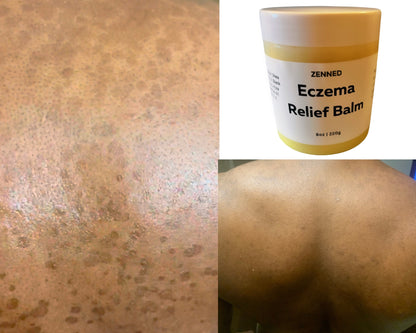 Eczema Balm