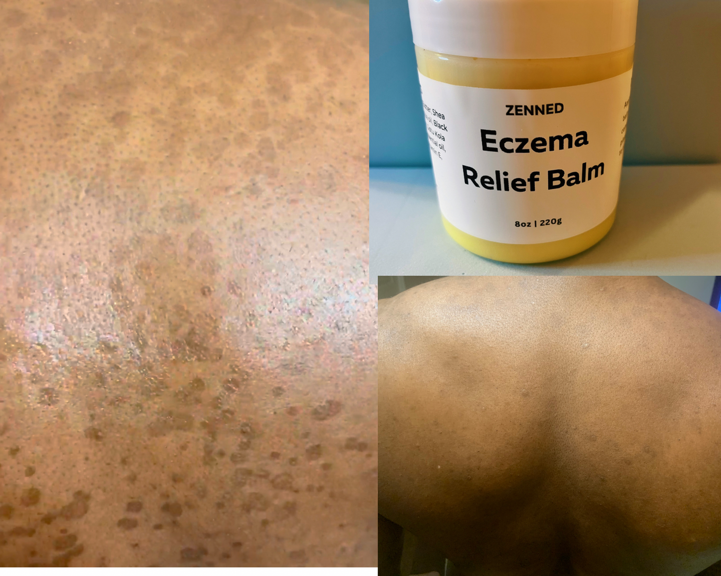 Eczema Balm